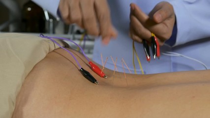 close up woman undergoing acupuncture treatment with electrical stimulator on back