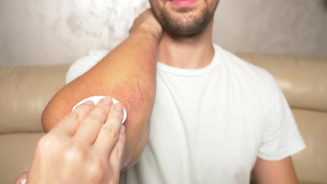 close-up. treatment of wounds with anti-inflammatory ointment. First aid for abrasions