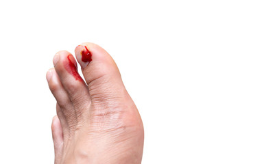 Fresh wounds on the floor man's toe nails on isolated white background with clipping path.