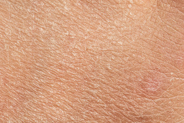 A closeup view on the lines and cracks of caucasian skin. Dried out and aging from exposure to sun, in need of moisturization and dermatologist.