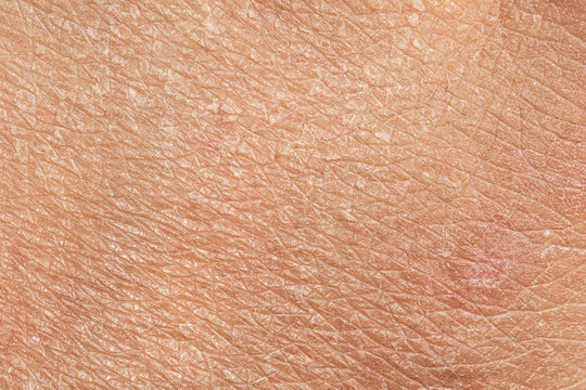A closeup view on the lines and cracks of caucasian skin. Dried out and aging from exposure to sun, in need of moisturization and dermatologist.