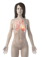 3d rendered medically accurate illustration of a womans lung cancer