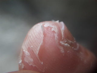A close up view on the foot and toes of a Caucasian adult with a healing blister and callus skin.