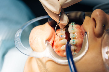 process of placing white dental braces to a Caucasian girl in a dental clinic with a dentist girl