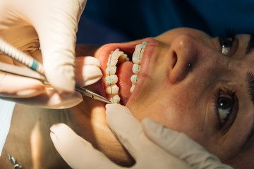 process of placing white dental braces to a Caucasian girl in a dental clinic with a dentist girl