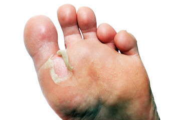 A bare leg with a painful heel is wound in kind. Women's feet are caused by new shoes. A cracked, terrible blister on a man’s heel.