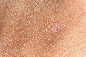 Dermatology and skincare concept with a macro view on the flaking skin of a caucasian person. Detailed view of the cracks and lines filling the frame.