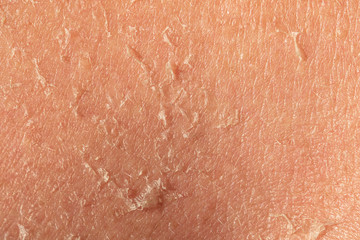 Fototapeta premium Peeling and flaking skin of a middle aged person is seen close-up, unhealthy skin due to overexposure to sun. Health and wellness concept with room for copy.