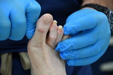 Podiatry Foot Fungus Bunion 