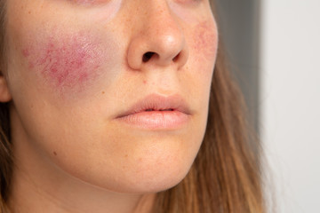 A young woman is seen suffering from a severe case of rosacea, resulting in red and purple superficial dilated blood vessels in the cheeks, with copy-space.