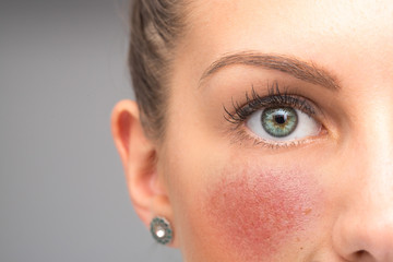 Fototapeta Red flushing cheeks are seen closeup, in the face of a stunning thirty something caucasian girl, permanent redness and small visible blood vessels, symptoms of rosacea with room for copy. obraz