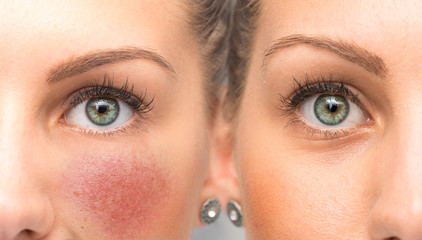 Before and after results of Brimonidine tartrate treatment for rosacea, a new medicated gel reduces redness and the appearance of blood vessels. - obrazy, fototapety, plakaty