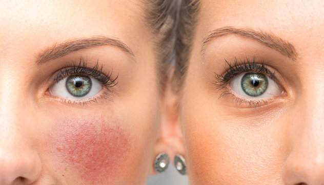 Before and after results of Brimonidine tartrate treatment for rosacea, a new medicated gel reduces redness and the appearance of blood vessels.
