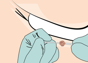  illustration of a Skin Tag Removal Methods