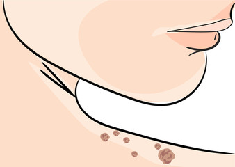  illustration of a Skin Tag Removal Methods