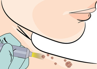  illustration of a Skin Tag Removal Methods