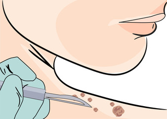  illustration of a Skin Tag Removal Methods
