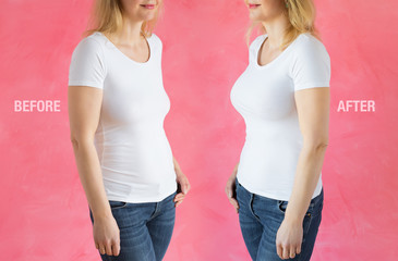 Woman before and after breast enhancement plastic surgery