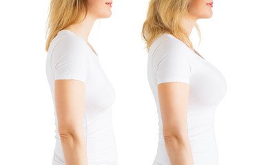 Woman before and after breast augmentation plastic surgery