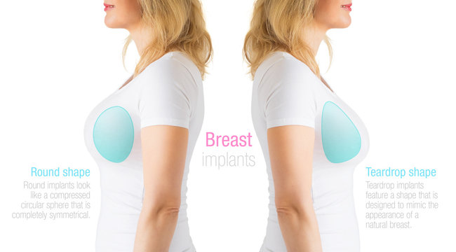 Image showing differences between round and teardrop shaped breast implants