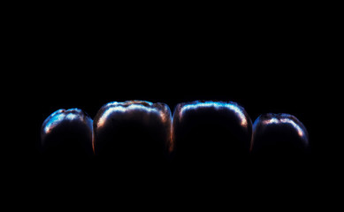 natural look ceramic veneers photoes