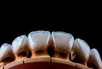 natural look ceramic veneers photoes