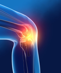 Painful osteoarthritic knee joint, medically 3D illustration - obrazy, fototapety, plakaty