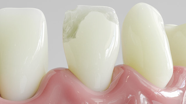 Tooth with caries attack in closeup - 3D Rendering