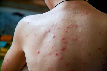 Varicella. A rash on the back of a boy. The child is sick with chicken pox. The benefits of...