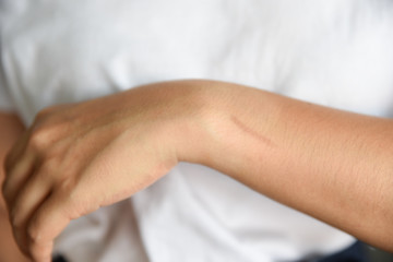 Closeup of woman showing the hand with a scar from appendicitis surgery.