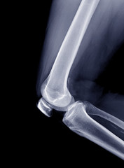 X-ray image of Right knee joint  lateral view and Lateral view. knee x-ray.