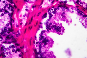Benign prostatic hyperplasia, light micrograph, photo under microscope. High magnification showing papillary projections inside the lumen of the glands
