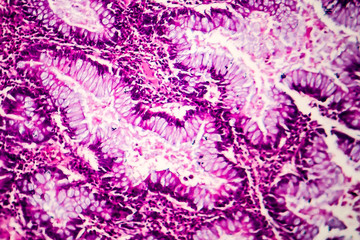 Villous colon adenocarcinoma, light micrograph, photo under microscope