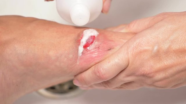 close-up. treatment of wounds with hydrogen peroxide. first aid for abrasions.