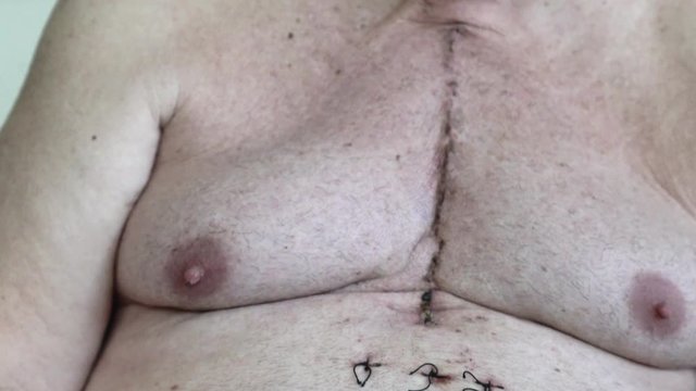 Scar from open heart surgery, where the sternum was cut in two, and the rib cage sprung. Below the scar holes show where the drains and pacemaker cables emerged. Image taken 12 days following surgery