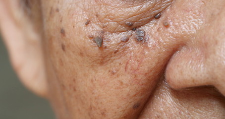 Close up skin tags on wrinkles skin of Asian woman face