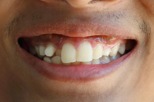 Close up crowding tooth of Asian man when smile