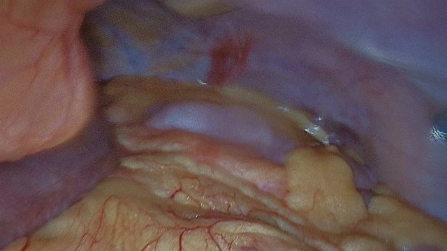 Endoscopy. Broadcast surgery to a monitor or TV screen. The internal organs of the human abdominal cavity. View through a laparoscopic video camera.