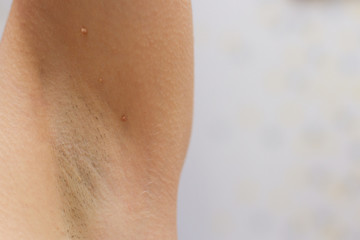 papillomas in the armpit on skin