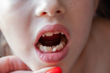 open baby mouth close-up. teeth grow in two rows, milk tooth falls out