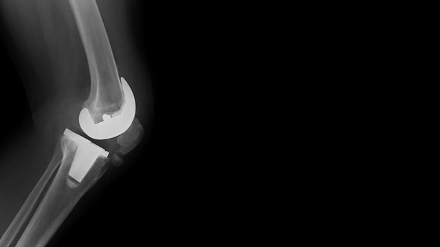 total knee arthroplasty x-ray image with red hight light footage 
