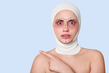 Young girl with bruises under eyes and wrapped in bandages, has arrows on face, shocked to hear unpleasent information about future operation, points aside with astonished and scared facial expression - obrazy, fototapety, plakaty