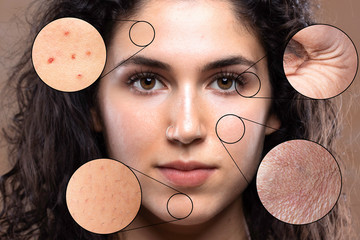 A close up portrait of a beautiful young caucasian girl. Magnified circles show problem areas of the skin causing stress and worry in millennials.