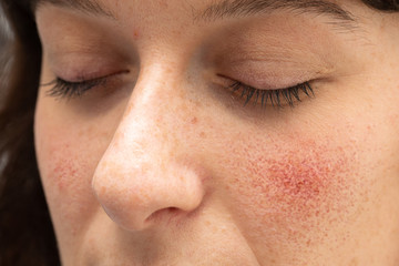 Problematic skin of a young caucasian woman is seen up-close. Red blotchy cheeks, open pores,...