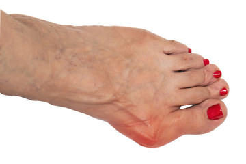 A closeup view on the bare foot of an elderly woman, showing a painful and swollen case of hallux valgus (bunion), red and inflamed isolated against a white background. - obrazy, fototapety, plakaty