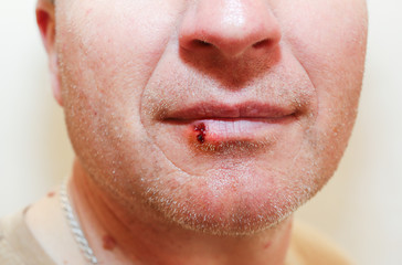 Herpes infection on the lips. Wound with blood on man's face. Medical care photo.