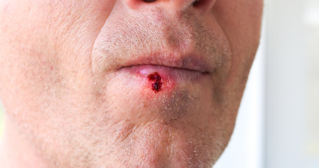 Obraz premium Herpes infection on the lips. Wound with blood on man's face. Medical care photo.