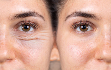 A young woman shows the before and after results of successful blepharoplasty surgery, corrective...