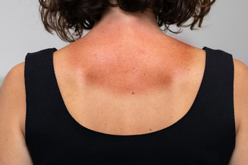 A close up view on the back of a caucasian girl wearing a black vest top, revealing severely burned...