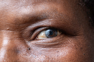 A closeup and macro view on the eye of an elderly black woman, a cloudy film is seen over the iris, symptomatic of a cataract, natural aging of the human eyes.